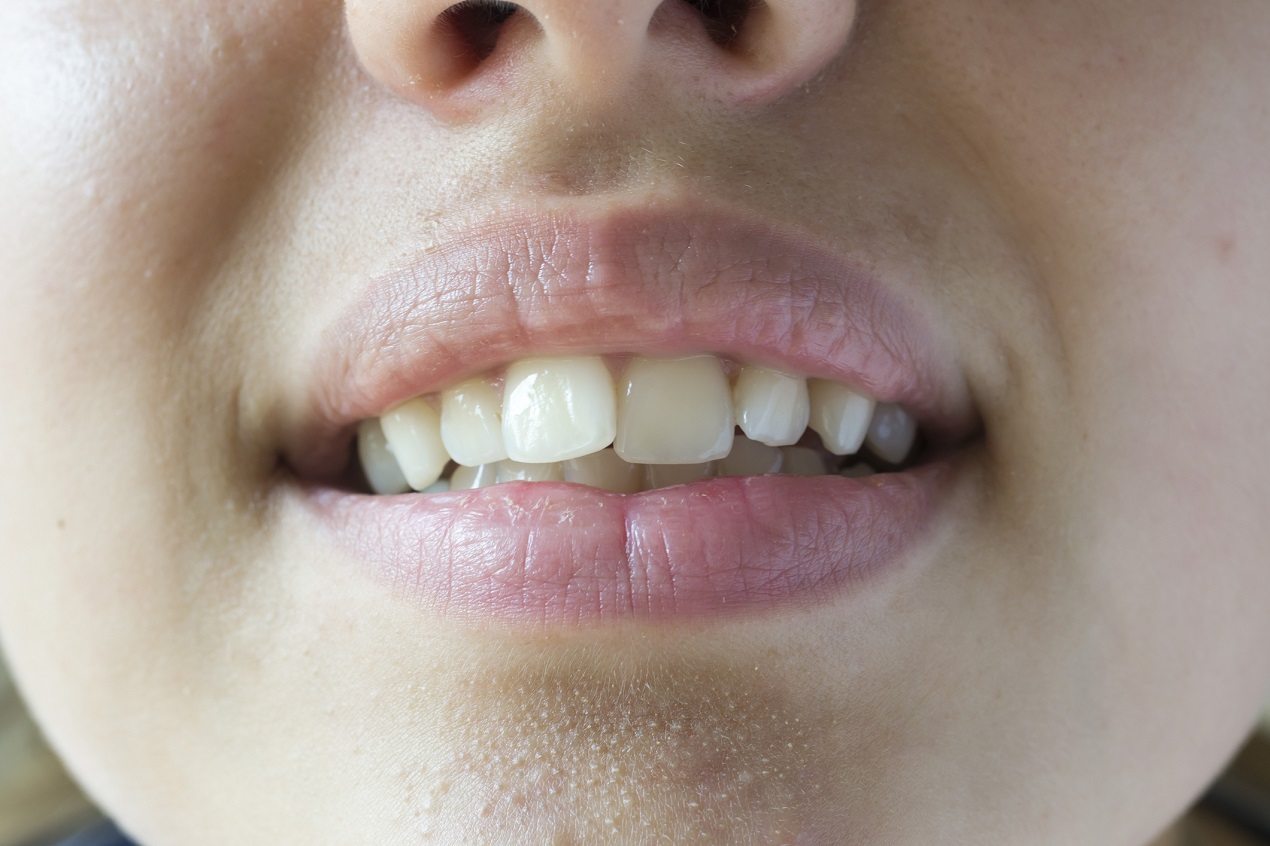 krzywe zęby obraz 2
