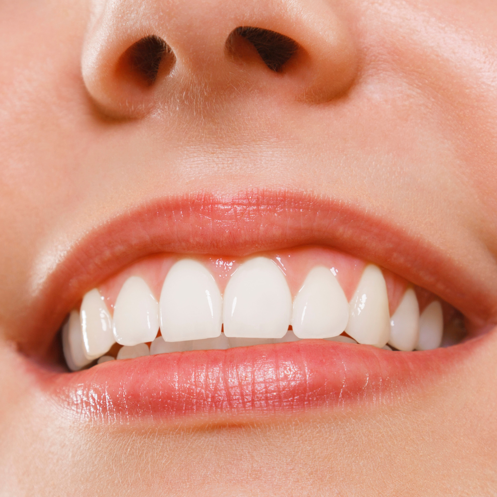 Bonding zębów - zalety zabiegu