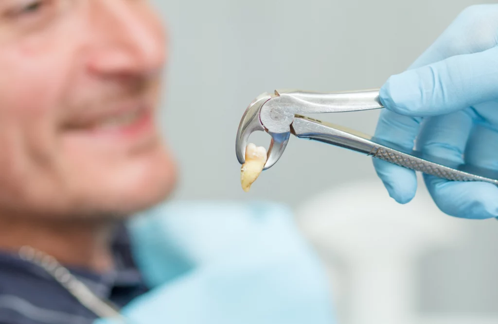 Stomatolog pokazuje pacjentowi wyrwany ząb